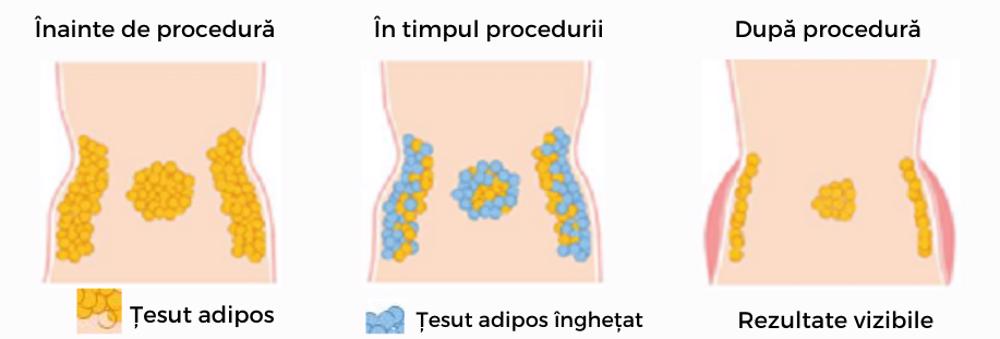 tratament criolipoliza cluj