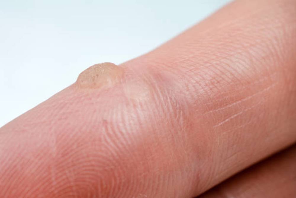 Ce cauzează negi pe mâini - Papiloamele – cauze, tipuri, metode de tratament - Cancer