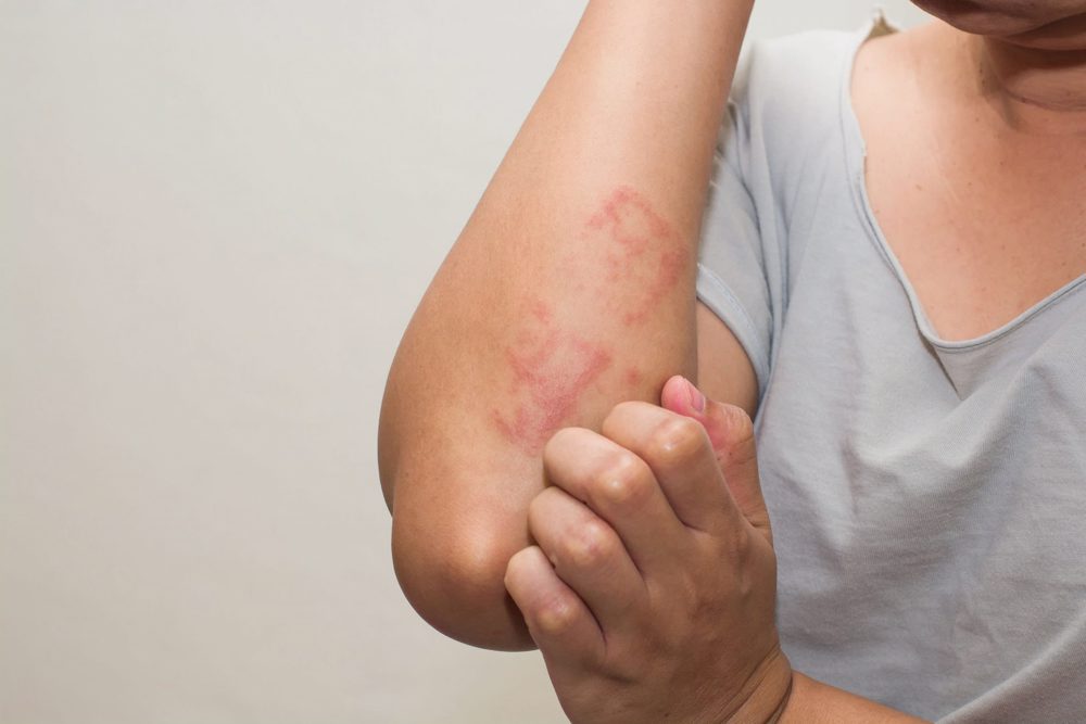 eczema cu picior de varicoza chilot profilactic în varicoza