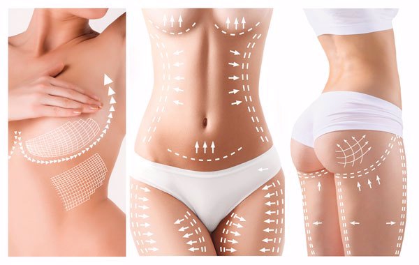 Liposuctie